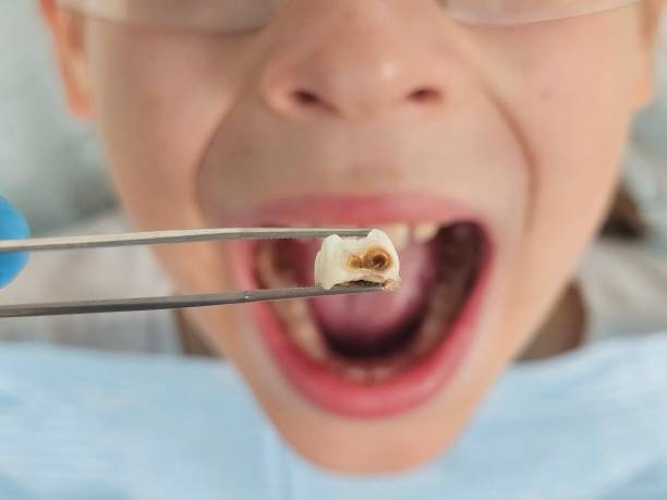 Best Dentist for Tooth Abscess  in Huber Ridge, OH